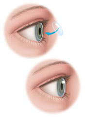 Corneal Transplantation Lawrenceville | Hopewell | Hamilton