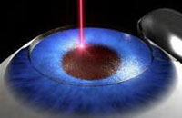 LASIK | Laser Vision Correction | Lawrenceville | Hopewell | Hamilton