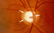 Glaucoma Treatment | Lawrenceville | Hopewell | Hamilton